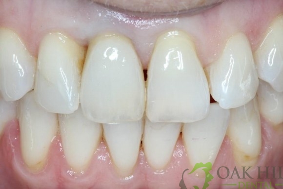 Gallery Dental Implants