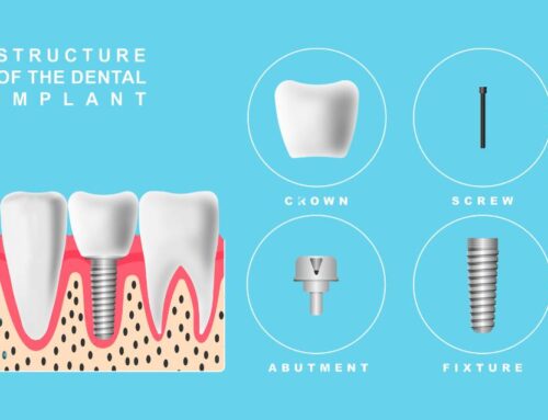 What Are Dental Implants? A Complete Guide