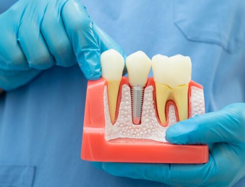 What’s the Real Deal with Dental Implant Costs in the UK?